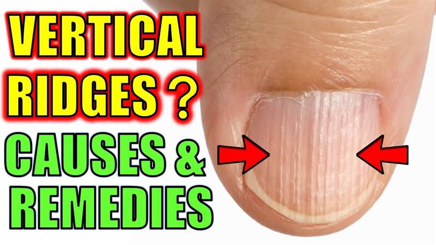 Do You Have Vertical Ridges On Your Nails? (Cause)